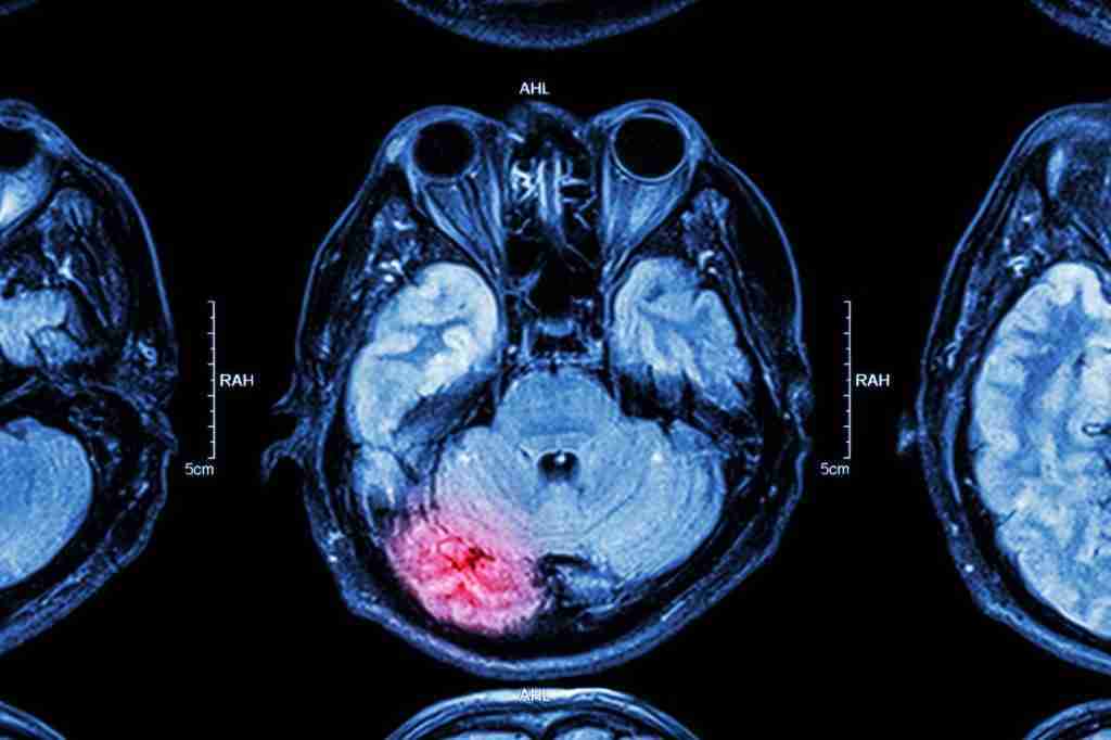 Acquired Brain Injury